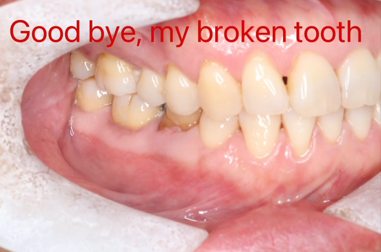 Broken tooth replacement clinical example