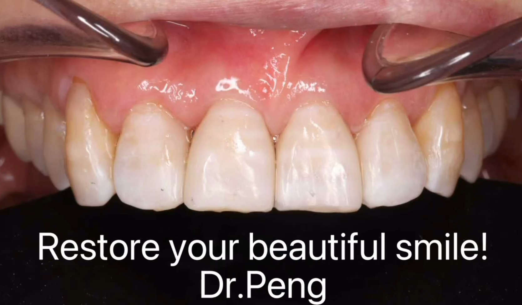 Clear aligner progress image