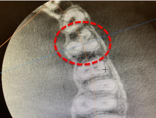 Root canal treatment X-ray detail