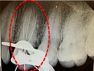 Root canal follow-up X-ray detail