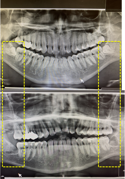 Wisdom teeth X-ray example for consultation