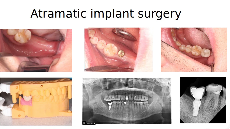 Implant planning collage used for consultation education