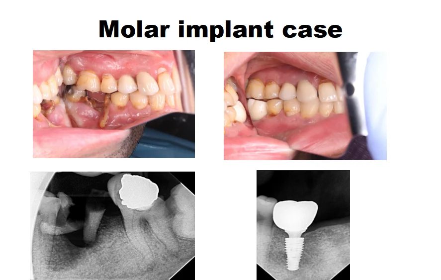 Molar implant restoration planning image